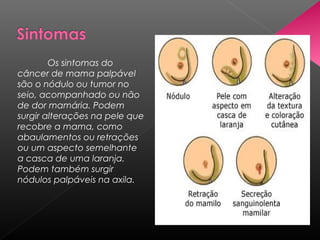 Os sintomas do
câncer de mama palpável
são o nódulo ou tumor no
seio, acompanhado ou não
de dor mamária. Podem
surgir alterações na pele que
recobre a mama, como
abaulamentos ou retrações
ou um aspecto semelhante
a casca de uma laranja.
Podem também surgir
nódulos palpáveis na axila.
 