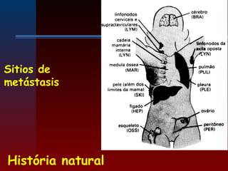 História natural
Sitios de
metástasis
 