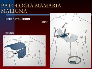 PATOLOGIA MAMARIA
MALIGNA
Prótesis
TRAM
RECONSTRUCCIÓN
 