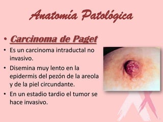 Anatomía Patológica
• Carcinoma de Paget
• Es un carcinoma intraductal no
invasivo.
• Disemina muy lento en la
epidermis del pezón de la areola
y de la piel circundante.
• En un estadio tardio el tumor se
hace invasivo.
 