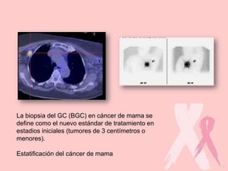 La biopsia del GC (BGC) en cáncer de mama se
define como el nuevo estándar de tratamiento en
estadios iniciales (tumores de 3 centímetros o
menores).
Estatificación del cáncer de mama
 