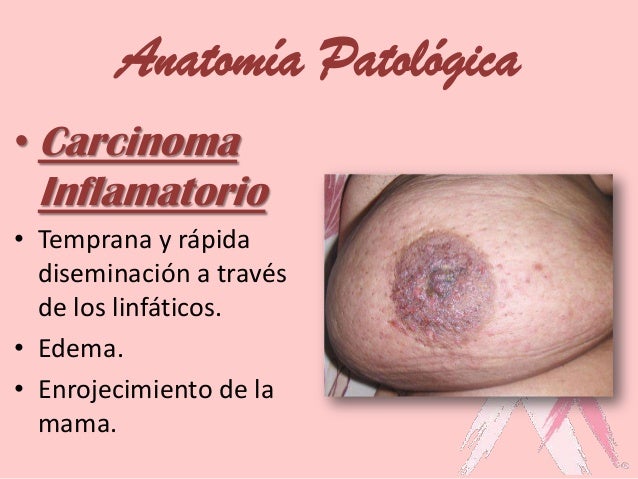 El pecho el aumento por la grasa