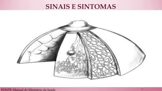 SINAIS E SINTOMAS 
FONTE: Manual do Ministério da Saúde 
13  