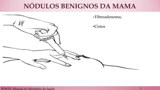 NÓDULOS BENIGNOS DA MAMA 
FONTE: Manual do Ministério da Saúde 
• Fibroadenoma; 
•Cistos 
14  