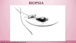 BIOPSIA 
FONTE: Manual do Ministério da Saúde 
23  