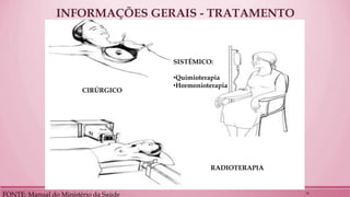 INFORMAÇÕES GERAIS - TRATAMENTO 
FONTE: Manual do Ministério da Saúde 
CIRÚRGICO 
RADIOTERAPIA 
SISTÊMICO: 
•Quimioterapia 
•Hormonioterapia 
24  