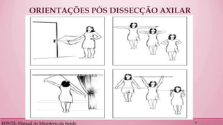 ORIENTAÇÕES PÓS DISSECÇÃO AXILAR 
FONTE: Manual do Ministério da Saúde 
26  