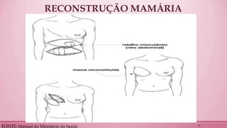 RECONSTRUÇÃO MAMÁRIA 
FONTE: Manual do Ministério da Saúde 
27  