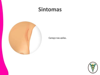 Sintomas
Caroço nas axilas.
 