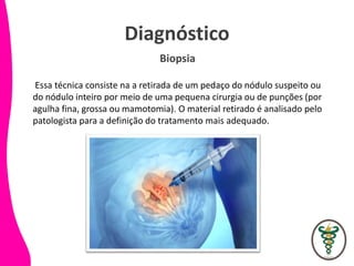 Diagnóstico
Essa técnica consiste na a retirada de um pedaço do nódulo suspeito ou
do nódulo inteiro por meio de uma pequena cirurgia ou de punções (por
agulha fina, grossa ou mamotomia). O material retirado é analisado pelo
patologista para a definição do tratamento mais adequado.
Biopsia
 