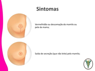 Sintomas
Vermelhidão ou descamação do mamilo ou
pele da mama;
Saída de secreção (que não leite) pelo mamilo;
 