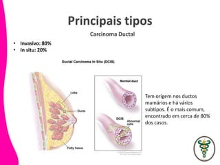 Principais tipos
Carcinoma Ductal
• Invasivo: 80%
• In situ: 20%
Tem origem nos ductos
mamários e há vários
subtipos. É o mais comum,
encontrado em cerca de 80%
dos casos.
 