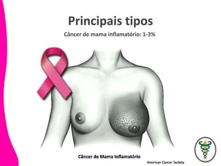 Principais tipos
Câncer de mama inflamatório: 1-3%
 