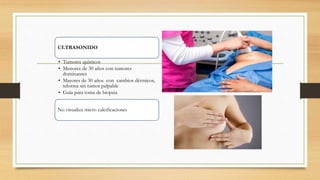 ULTRASONIDO
• Tumores quísticos
• Menores de 30 años con tumores
dominantes
• Mayores de 30 años con cambios dérmicos,
telorrea sin tumor palpable
• Guía para toma de biopsia
No visualiza micro calcificaciones
 