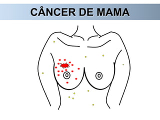 CÂNCER DE MAMA
 