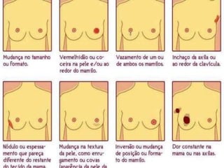 CÂNCER DE MAMA
Sintomas