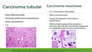Cáncer de mama Felix.pdf