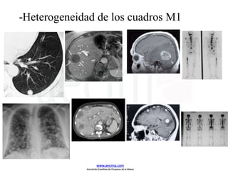 -Heterogeneidad de los cuadros M1
www.aecima.com
Asociación Española de Cirujanos de la Mama
 