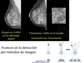 Avances en la detección
por métodos de imagen
www.aecima.com
Asociación Española de Cirujanos de la Mama
 