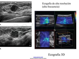 Ecogafía de alta resolución
(alta frecuencia)
Ecografía 3D
www.aecima.com
Asociación Española de Cirujanos de la Mama
 
