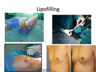 Lipofilling
www.aecima.com
Asociación Española de Cirujanos de la Mama
 