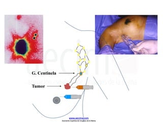 Tumor
G. Centinela
www.aecima.com
Asociación Española de Cirujanos de la Mama
 