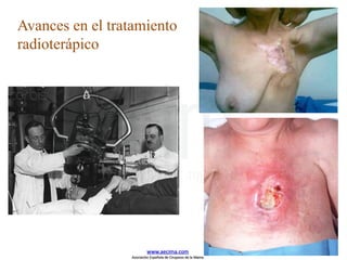 Avances en el tratamiento
radioterápico
www.aecima.com
Asociación Española de Cirujanos de la Mama
 