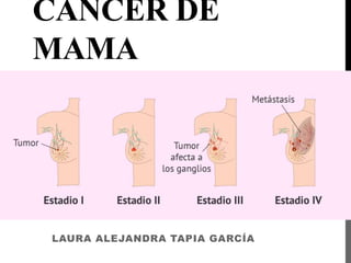 CÁNCER DE
MAMA
LAURA ALEJANDRA TAPIA GARCÍA
 
