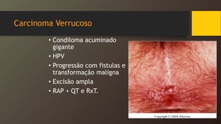 Carcinoma Verrucoso
• Condiloma acuminado
gigante
• HPV
• Progressão com fistulas e
transformação maligna
• Excisão ampla
• RAP + QT e RxT.
 