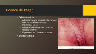 Doença de Paget
• Extramamária:
• Adenocarcinoma intraepitelial raro em
área de epitélio escamoso.
• Incidência: Idosos
• Placas eczematóide com ulcera ou
lesões papilares.
• Hiperceratose / líquen / eczema
• Excisão ampla
 