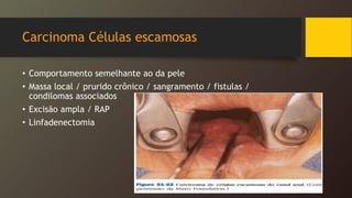 Carcinoma Células escamosas
• Comportamento semelhante ao da pele
• Massa local / prurido crônico / sangramento / fistulas /
condilomas associados
• Excisão ampla / RAP
• Linfadenectomia
 