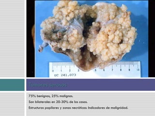 75% benignos, 25% malignos.
Son bilaterales en 20-30% de los casos.
Estructuras papilares y zonas necróticas: Indicadores de malignidad.
Tumores serosos
 