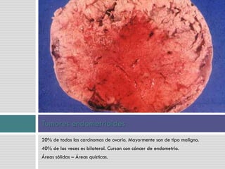 20% de todos los carcinomas de ovario. Mayormente son de tipo maligno.
40% de las veces es bilateral. Cursan con cáncer de endometrio.
Áreas sólidas – Áreas quísticas.
Tumores endometrioides
 