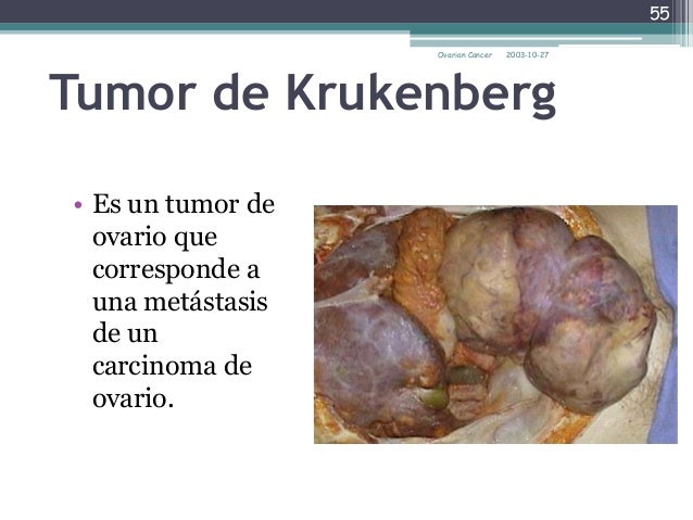 Krukenberg Tumour Signet Ring Krukenberg Tumour Signet Ring