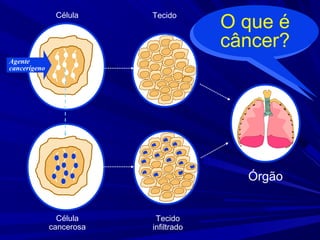 Órgão
Tecido
Tecido
infiltrado
Célula
Célula
cancerosa
Agente
cancerígeno
O que é
câncer?
 