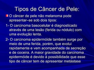 Tipos de Câncer de Pele:Tipos de Câncer de Pele:
O câncer de pele não melanoma podeO câncer de pele não melanoma pode
apresentar–se sob dois tipos:apresentar–se sob dois tipos:
1- O carcinoma basocelular é diagnosticado1- O carcinoma basocelular é diagnosticado
através de uma lesão (ferida ou nódulo) comatravés de uma lesão (ferida ou nódulo) com
uma evolução lenta.uma evolução lenta.
2- O carcinoma epidermóide também surge por2- O carcinoma epidermóide também surge por
meio de uma ferida, porém, que evoluimeio de uma ferida, porém, que evolui
rapidamente e vem acompanhada de secreçãorapidamente e vem acompanhada de secreção
e de coceira. A maior gravidade do carcinomae de coceira. A maior gravidade do carcinoma
epidermóide é devido à possibilidade que esseepidermóide é devido à possibilidade que esse
tipo de câncer tem de apresentar metástasetipo de câncer tem de apresentar metástase
 