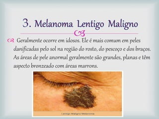  Geralmente ocorre em idosos. Ele é mais comum em peles
danificadas pelo sol na região do rosto, do pescoço e dos braços.
As áreas de pele anormal geralmente são grandes, planas e têm
aspecto bronzeado com áreas marrons.
 