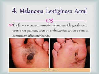 É a forma menos comum de melanoma. Ele geralmente
ocorre nas palmas, solas ou embaixo das unhas e é mais
comum em afroamericanos.
 