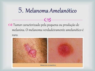 
 Tumor caracterizado pela pequena ou produção de
melanina. O melanoma verdadeiramente amelanótico é
raro.
 