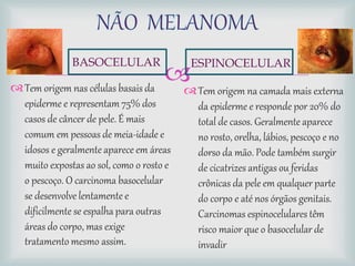 
BASOCELULAR
Tem origem nas células basais da
epiderme e representam 75% dos
casos de câncer de pele. É mais
comum em pessoas de meia-idade e
idosos e geralmente aparece em áreas
muito expostas ao sol, como o rosto e
o pescoço. O carcinoma basocelular
se desenvolve lentamente e
dificilmente se espalha para outras
áreas do corpo, mas exige
tratamento mesmo assim.
ESPINOCELULAR
Tem origem na camada mais externa
da epiderme e responde por 20% do
total de casos. Geralmente aparece
no rosto, orelha, lábios, pescoço e no
dorso da mão. Pode também surgir
de cicatrizes antigas ou feridas
crônicas da pele em qualquer parte
do corpo e até nos órgãos genitais.
Carcinomas espinocelulares têm
risco maior que o basocelular de
invadir
 