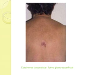 Carcinoma basocelular: forma plano-superficial
 