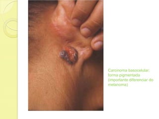 Carcinoma basocelular:
forma pigmentada
(importante diferenciar do
melanoma)
 