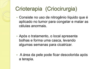 Crioterapia (Criocirurgia)
 Consiste no uso de nitrogênio líquido que é
aplicado no tumor para congelar e matar as
células anormais.
 Após o tratamento, o local apresenta
bolhas e forma uma casca, levando
algumas semanas para cicatrizar.
 A área da pele pode ficar descolorida após
a terapia.
 