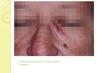 Carcinoma basocelular: forma nódulo-
ulcerativa
 