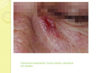 Carcinoma basocelular: forma nódulo- ulcerativa
em detalhe
 