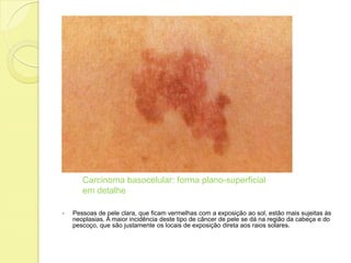  Pessoas de pele clara, que ficam vermelhas com a exposição ao sol, estão mais sujeitas às
neoplasias. A maior incidência deste tipo de câncer de pele se dá na região da cabeça e do
pescoço, que são justamente os locais de exposição direta aos raios solares.
Carcinoma basocelular: forma plano-superficial
em detalhe
 