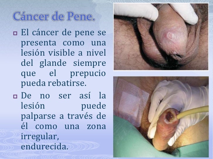 Que modo el mejor miembro para el aumento