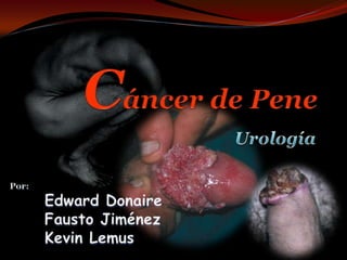 Cáncer de Pene Urología Por: 	Edward Donaire 	Fausto Jiménez 	Kevin Lemus 