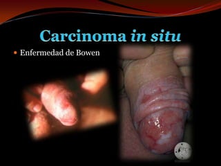 Enfermedad de BowenCarcinoma in situ