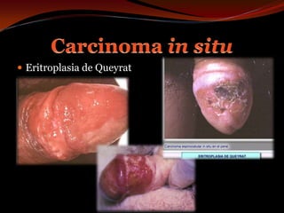 Eritroplasia de QueyratCarcinoma in situ